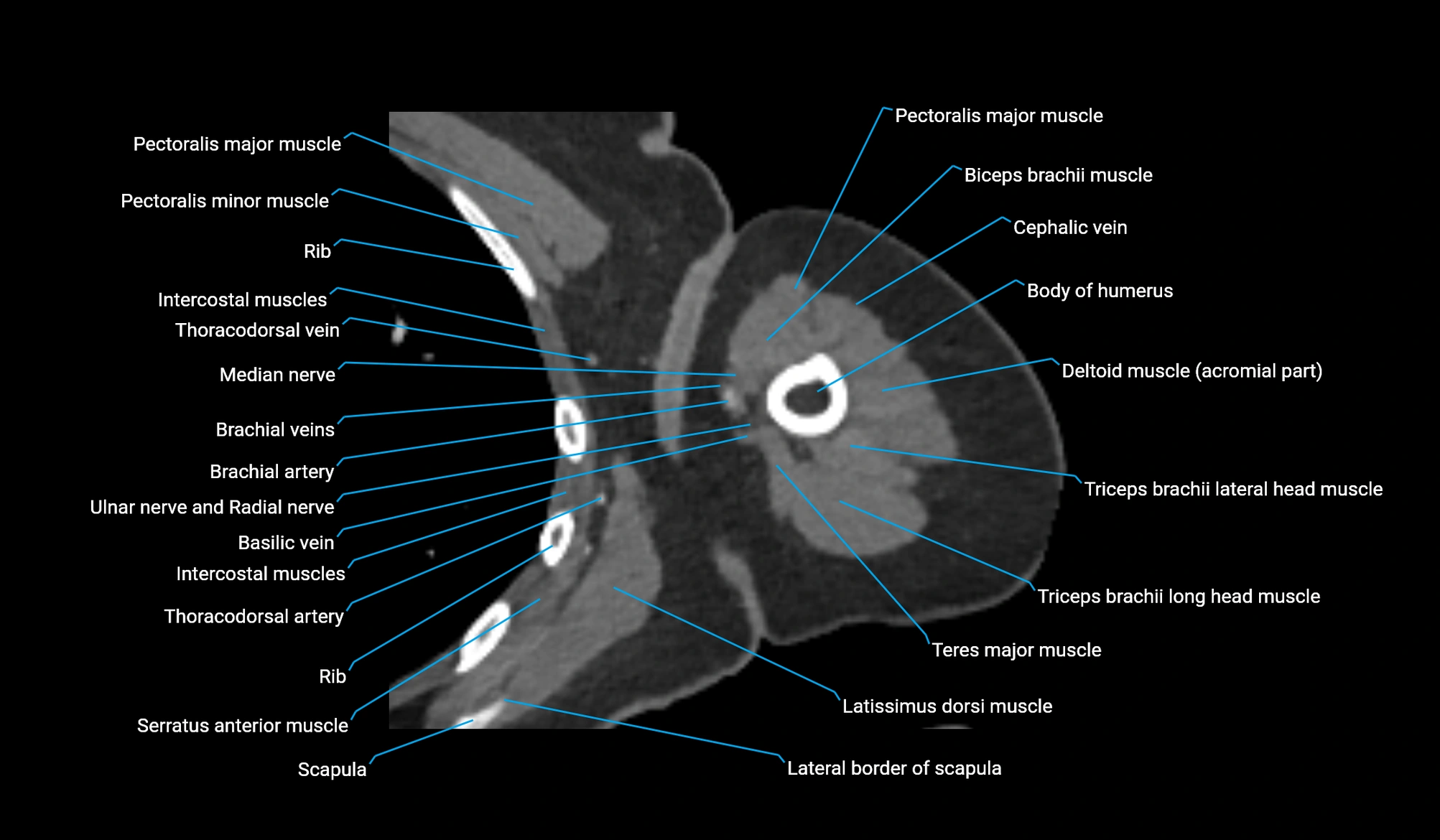 CT upper arm axial  cross sectional anatomy labelled radiology image -00174.webp